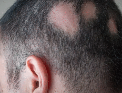 Alopecia Areata: Causes, Symptoms, and Effective Natural Treatments